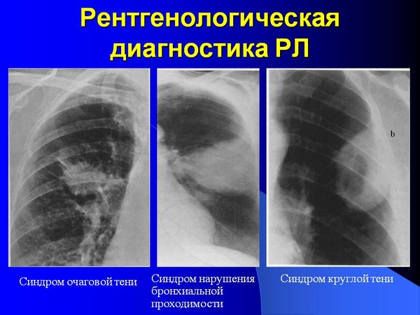 Рентген на дому Москва, Флюорография на дом Москва, Цифровой рентген на дому Москва, Травматолог на дом Москва, ЛОР на дом Москва , Стоматолог на дом, Нарколог на дом Москва, Психолог на дом, Невролог на дом, УЗИ на дому Москва, ЭКГ на дому Москва, Анализы на дому Москва, бесплатно по полису ДМС добровольное медицинское страхование. 
Балканская рамка - ( аренда и продажа) ; 
#рентгеннадому #рентгеннадомуМосква 
Рентген на дому Москва, Подмосковье, Московская область, Вороново, Красная Пахра, Дмитров, Сергеев Пасад, Орехово Зуево, Новые Ватутинки, Мытищи, Одинцово, Люберцы, Подольск, Троицк, Московский, Красногорск, Лобня, Видное, Новая Москва, Домодедово , Внуково, Красногорск , Дедовск, Истра, Клин, Чехов, Серпухов, 
#рентген_на_дому_шейки_бедра #флюорография_на_дом
Как сделать мешочки для душа из овсяных хлопьев? 
Кроме того, что овсянка очень эффективно борется с прыщами и другими симптомами акне, она помогает расслабить мышцы и одновременно поддерживать их в тонусе, а еще прекрасно подходит для чувствительной кожи! 
Овсянка сегодня, выражаясь современным языком, в тренде. Она снова вошла в моду благодаря своим многочисленным полезным для здоровья свойствам, и многие уже просто не представляют свой ежедневный рацион без этого супер питательного злака. 
Но знаете ли вы, что овсянка является еще и превосходным средством для ухода за кожей? Ее целебные свойства известны с древних времен, и в нашей сегодняшней статье мы поделимся с вами одним очень простым, экономичным и полезным рецептом, чтобы и вы смогли оценить их по достоинству. 
Полезные свойства овсянки для гладкой и шелковистой кожи 
1. Очищающее действие 
Овсянка — абсолютно натуральное средство, при помощи которого можно добиться исключительной чистоты своей кожи. Она способна глубоко очистить поры, удалив из них весь лишний жир и загрязнения, но главное достоинство овсянки заключается в том, что благодаря содержанию в ней белков она способствует поддержанию баланса структуры кожных покровов (сбалансированного уровня pH). 
2. Естественное увлажнение кожи 
Действительно, в овсянке содержатся липиды, которые обеспечивают коже необходимое увлажнение, предотвращая обезвоживание и одновременно защищая от негативного воздействия внешних факторов и поддерживая ее естественную защитную функцию. 
3. Овсянка — превосходное отшелушивающее средство 
Благодаря своим очищающим и увлажняющим свойствам, овсянка становится отличным решением для удаления омертвевших клеток кожи с ее поверхности. Таким образом, регулярно используя овсянку для ухода за кожей, можно будет навсегда забыть о том, что такое черные точки, прыщи угри и другие несовершенства. 
Нельзя не отметить и другое полезное свойство овсянки: она борется с самой причиной возникновения акне, а именно способствует уменьшению выработки кожного сала (внешне его избыток проявляется как жирный блеск кожи). Так что очень рекомендуем это натуральное средство! 
4. Уменьшает раздражение кожи 
Эффект просто великолепный: овсянка быстро успокоит кожу, если у вас появилось какое-либо раздражение. Она будет эффективна и в более серьезных случаях, например в таких, как экзема, дерматит, крапивница, псориаз и т.д. 
Овсянка обладает успокаивающим и заживляющим свойствами, поэтому имейте это в виду, ведь раздражение может возникнуть совершенно неожиданно у любого человека.
#рентген_в_москве, #рентген_легких, #перелом_шейки_бедра, #шейка_бедра, #сделать_рентген, #сделать_рентген_на_дому, #вызвать_врача, #вызвать_врача_на_дом, #врач_на_дом, #вызвать_травматолога, #травматолог_на_дом, #перелом_ребер, #вправить_вывих, #травматолог, #перелом, #травма #вывих, #флюорография, #флюорография_на_дому, #ушиб, #пневмония #функциональная_кровать #рама_балканского 
#рентгеннадому #рентгеннадомуМосква 
#Рама_Балканского 
#травматолог_на_дом_Москва 
#рентген_на_дому_шейки_бедра_Москва 
#рентген_на_дому_лёгкие_Москва 
#рентген_на_дому_позвоночника_Москва 
#рентген_на_дому_отзывы_Москва 
#сделать_рентген_на_дому_Москва 
#вызвать_рентген_на_дом_Москва 
#рентген_на_дому_тазобедренного_сустав 
#Московский_рентген_Рентген_на_дому_шейки_бедра